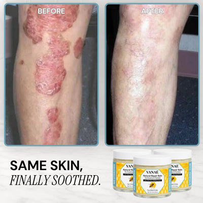 VANAÉ Natural Repair Balm — For Eczema & Psoriasis