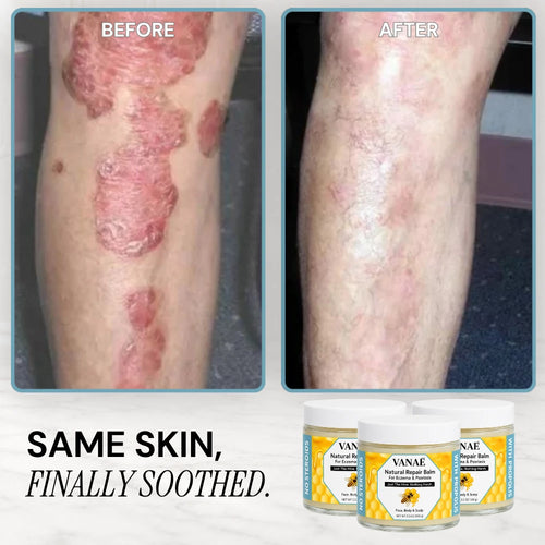 VANAĒ Natural Repair Balm For Eczema & Psoriasis