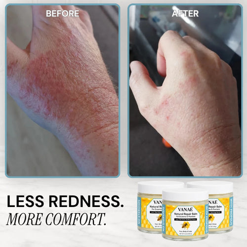VANAĒ Natural Repair Balm For Eczema & Psoriasis