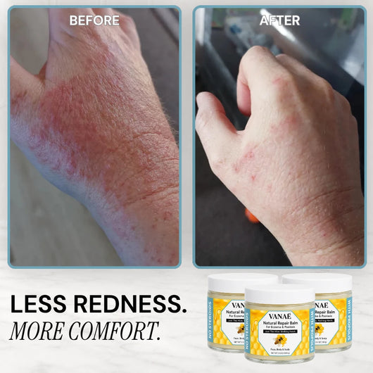 VANAÉ Natural Repair Balm — For Eczema & Psoriasis