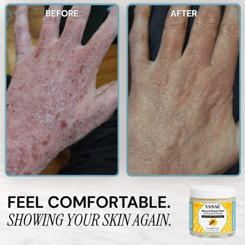 VANAĒ Natural Repair Balm For Eczema & Psoriasis