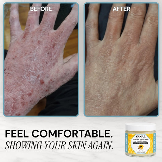 VANAÉ Natural Repair Balm — For Eczema & Psoriasis